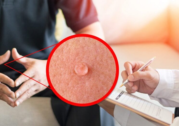 Especialista-en-verrugas-genitales-en-Toluca-1024x526