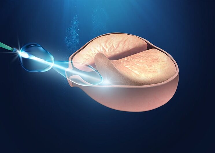 Laser-Holmium-Prostata-min